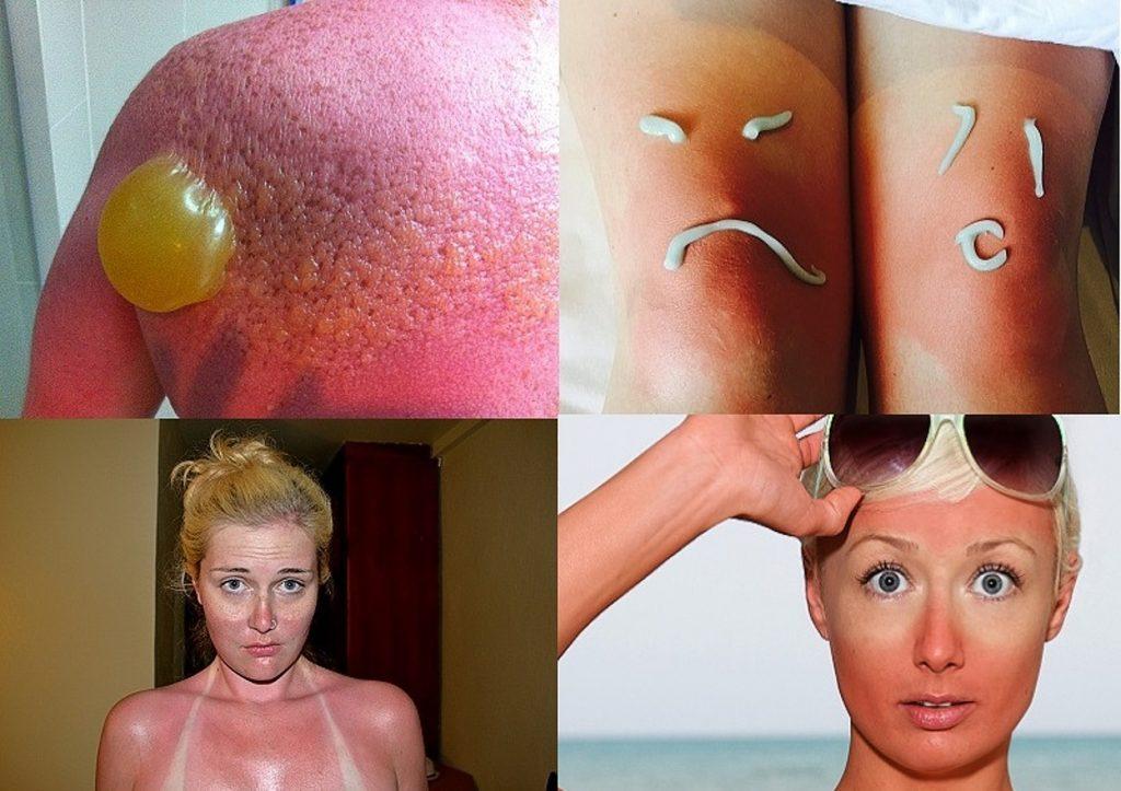 Чтобы не получить солнечных ожогов необходимо использовать специальные крема